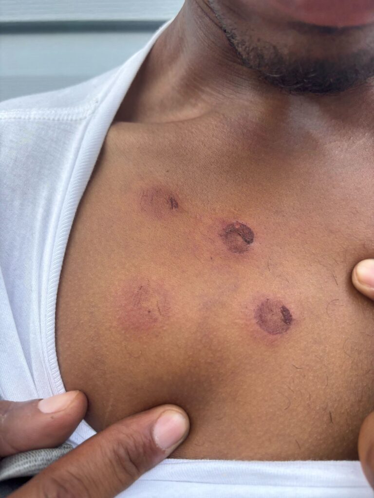 Devin Hunt shows four dark red welts on his upper chest from IMPD Officer Steven Rzyski shooting him point-blank with a pepper ball gun
