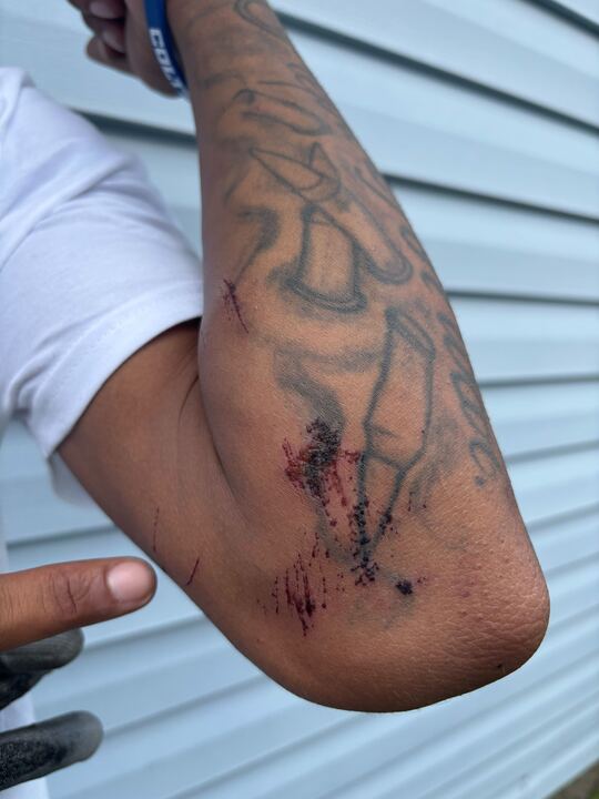 Devin Hunt shows red scabs on his arm from his violent wrongful arrest by IMPD officers